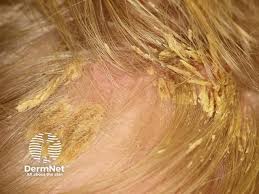 Image result for white scabs on the head in children
