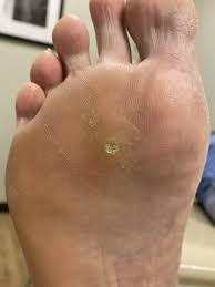 Unfortunately foot cancer is a reality for thousands of americans each and every year. Foot Skin Cancer Dr Nicholas Campitelli