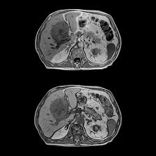This topic is answered by a medical i just had an mri for about an hour and over half way through the same thing happened to me, extreme pain in right hip socket and now bruising that is. Ct Vs Mri What S The Difference Thumb Mri Michigan S Largest Open Bore Mri Center