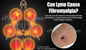 Can Lyme Cause Fibromyalgia