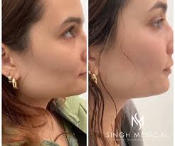 Rejuvenation Before and After