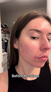 Accutane Before and After Purge