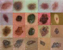 There are different forms of skin cancer, and the most common are first, a doctor will examine a person's skin and take their medical history. Symptoms Skin Cancer All About Skin Cancer Treatment Relief
