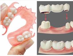 Check spelling or type a new query. Dental Care Lombok Mengenal Macam Macam Gigi Palsu Gigi Palsu Lepasan Merupakan Gigi Palsu Yg Bisa D Lepas Pasang Oleh Pasien Sendiri Gambar Sebelah Kiri Harganya Lebih Ekonomis Dbandingkan Gigi Palsu