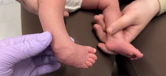 Image result for Clubfoot
