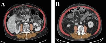 Methodology Clinical Applications And Future Directions Of Body Composition Analysis Using Computed Tomography Ct Images A Review Sciencedirect