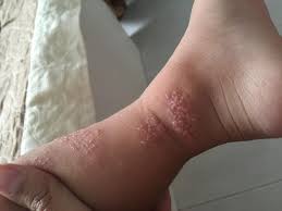 Walaupun begitu, pengetahuan tentang bisa kumbang ini telah diketahui sejak 1200 tahun lepas oleh masyarakat china, yang menggunakan bisanya untuk membuang tatu. Semut Charlie Jangan Jerit Hembus Atau Alirkan Air Untuk Buang Dari Badan Free Malaysia Today Fmt