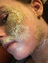 Image result for yellow scabs on the face in children