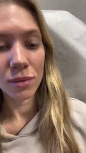 Thoughtful planning > rushing results 🧠💉 This lip enhancement was  completed over three treatments to support tissue adaptation and achieve a  soft, natural outcome 👄✨ Swipe to see where we started and