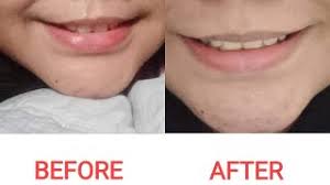 So, for the sake of my lipstick selfies and the benefit of my colleagues, the 'tash has to go. Upper Lip Laser Hair Removal Before And After Youtube