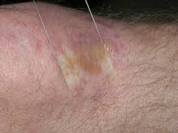 Image result for Diascopy