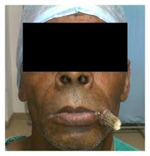 Image result for cornu cutaneum)