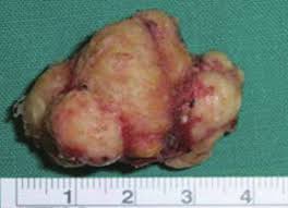 Image result for Tonsillolith