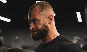 Before and After Chris Bumstead's Hair Transplant