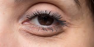 Trube Augen Ursachen Erkrankungen Und Behandlung Heilpraxis