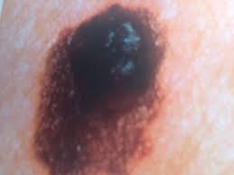 Føflekker finnes hos en til tre prosent av nyfødte. Erikas Hudpleie Er Foflekken Ondartet Tips Til A Facebook