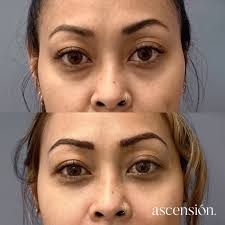 Recomendações de cirurgiões plásticos que realizam blefaroplastia e seu  custo estimado : r/Panama