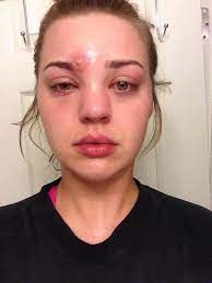 Continue applying ice to the bruise every hour for 20 minutes. You Ll Never Squeeze A Spot Again After Seeing What Happened To This Woman S Face