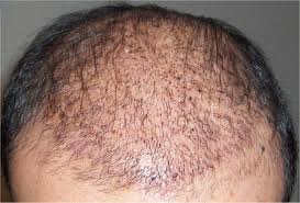 A hurricane and marketing woes couldn't keep these persistent franchisees down. Quanto Tempo Ci Vuole Per Guarire Da Un Trapianto Di Capelli