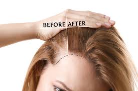 Menopause is a time of extreme hormonal changes that typically occurs around the late 40s and early 50s. Hair Loss Women Beyond Smile Hair Transplant