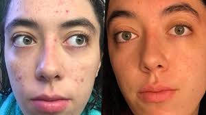 From hot and flashy, angie has posted photos that span five years' worth of results from using tretinoin cream. Tretinoin For Acne Usage Benefits Efficacy And Side Effects