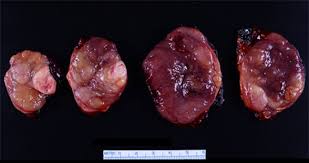 Bleeding is the most common sign of endometrial cancer in postmenopausal women. Adrenocortical Cancer Presenting As Postmenopausal Bleeding A Case From The Endocrine Teaching Clinics Mayo Clinic