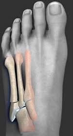Not so for the french surgeon. Jones Fracture Lisfranc Fracure Best Podiatrist Los Angeles University Foot And Ankle Institute