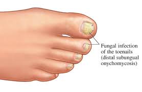 Image result for onychomycosis