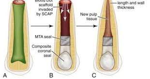 Regenerative Endodontic Therapy News Endodontics Pediatric Dentistry Dentistry