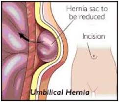 In infants they are usually painless, becoming obvious only when the babies cry or strain during coughing or bowel movements. Umbilical Hernia Open St George Surgical Center