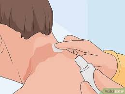 Image result for Notalgia Paresthetica