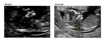 The letters that are next to the numbers on an ultrasound represent different measurements of the baby. Increased Nuchal Translucency Prenatal Screening Ontario
