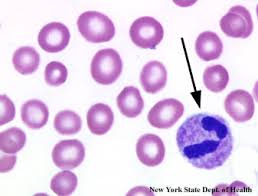 Erythrocyte sedimentation rate hypersegmented cells lymphoma. White Blood Cell Inclusions And Abnormalities Hematology