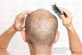 أهم 10 خطوات لزيادة كثافة الشعر للرجال ثقف نفسك