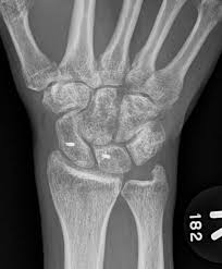 Image result for Scapholunate Dislocation