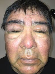 400 caravanes des gens du voyage doivent quitter le département dit le préfet l'installation des gens du voyage le 25 juillet à merlevenez (morbihan) a révélé des tensions. A Navajo Patient With Morbihan S Disease Insight Into Oculoplastic Treatment Of A Rare Disease Abstract Europe Pmc