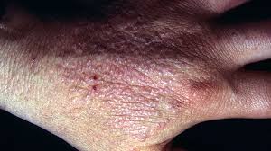 Some herpes canker sores develop a thin, white coating and burn when touched while they healing. Is It Herpes Or Something Else Everyday Health