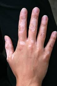 Image result for Vitiligo