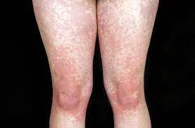 updated january 2020 connect with us: Mononucleosi Infettiva Infezioni Manuale Msd Versione Per I Pazienti
