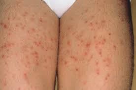 Image result for folliculitis symptoms