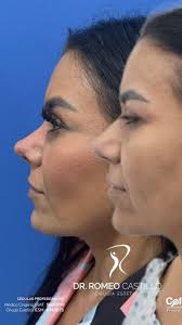 Ella es Celene y esta es su experiencia en una rinoplastia con el Dr. Romeo  Castillo, si buscas realzar tus facciones y esculpir tu figura con  seguridad y experiencia, agenda tu valoración hoy mismo. ...
