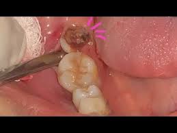 Trus gigi depan saya juga berwarna hitam dan agak berlubang apakah bisa diperbaiki dok? Pencabutan Gigi Geraham Bungsu Dokter Gigi Tri Putra Youtube