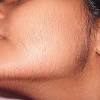In the above link i have written remedies for harmonal balance. 1