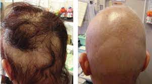 More severe reactions cause marked reddening, blistering and swelling of the eyelids, scalp, face and neck. A A Female With An Allergic Reaction To Hair Dye With Severe Hair Download Scientific Diagram