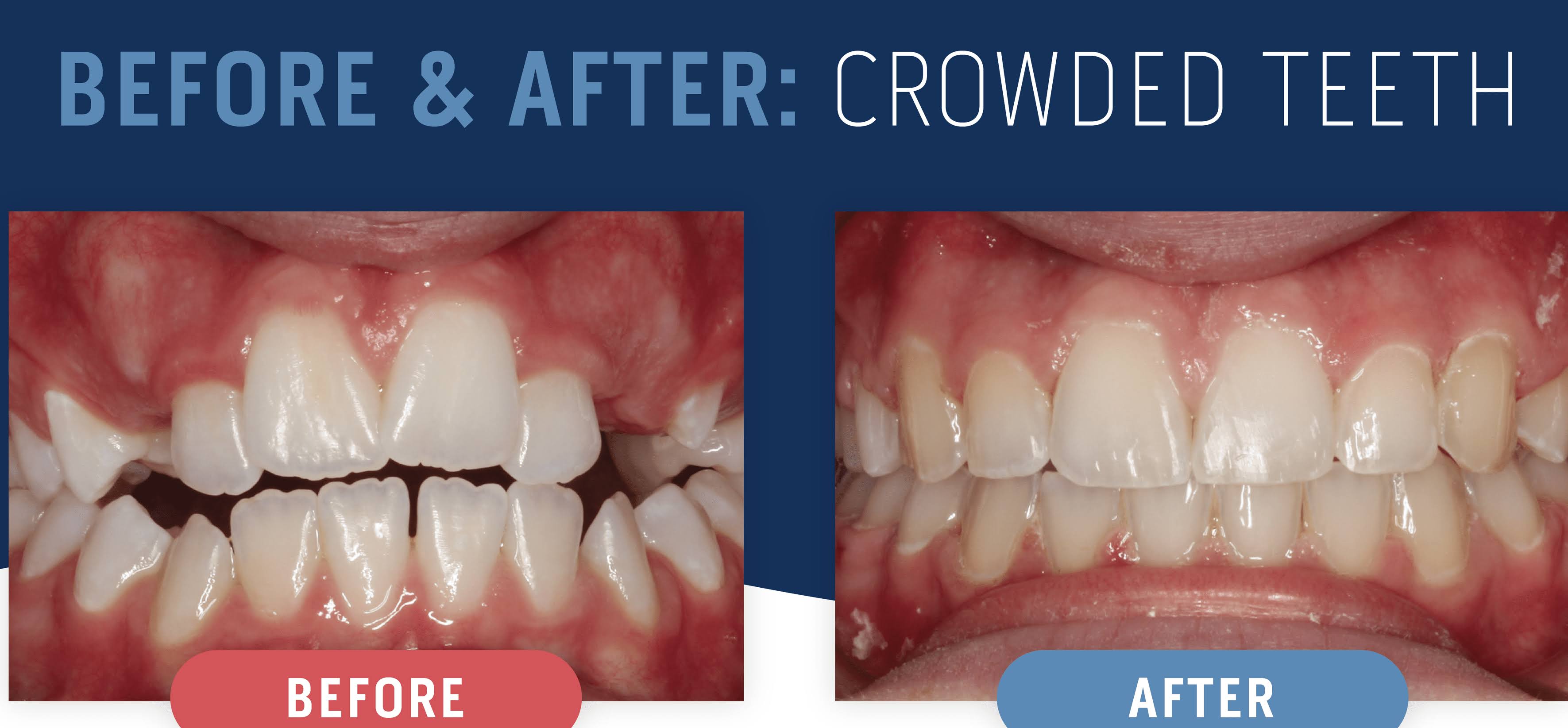 DENTAL BRACES product image