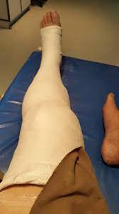 Di bawah lutut terdapat dua tulang kaki lainnya yaitu tibia atau dikenal dengan tulang kering dan fibula atau tulang betis. Close Fracture Tibia Patah Tulang Kering Kaki Kiri Atas Ju Flickr