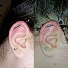 Preventing an ear infection after you've just gotten your ears pierced is fairly simple. Piercing Infection 4 Ways To Heal Fast Infected Ear Nose Piercing