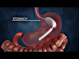 Intragastric Balloon For Weight Loss Mayo Clinic Youtube