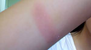 They usually do not need intensive medical treatment unless they cover a large area or show signs of infection. Burns Pictures Of Types And Symptoms