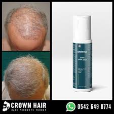 Hair Transplant Operation Is The Most Effective Way To Have Your Hair Back And After Hair Transplant You Want To Maxim Crown Hairstyles Volume Hair Bright Hair